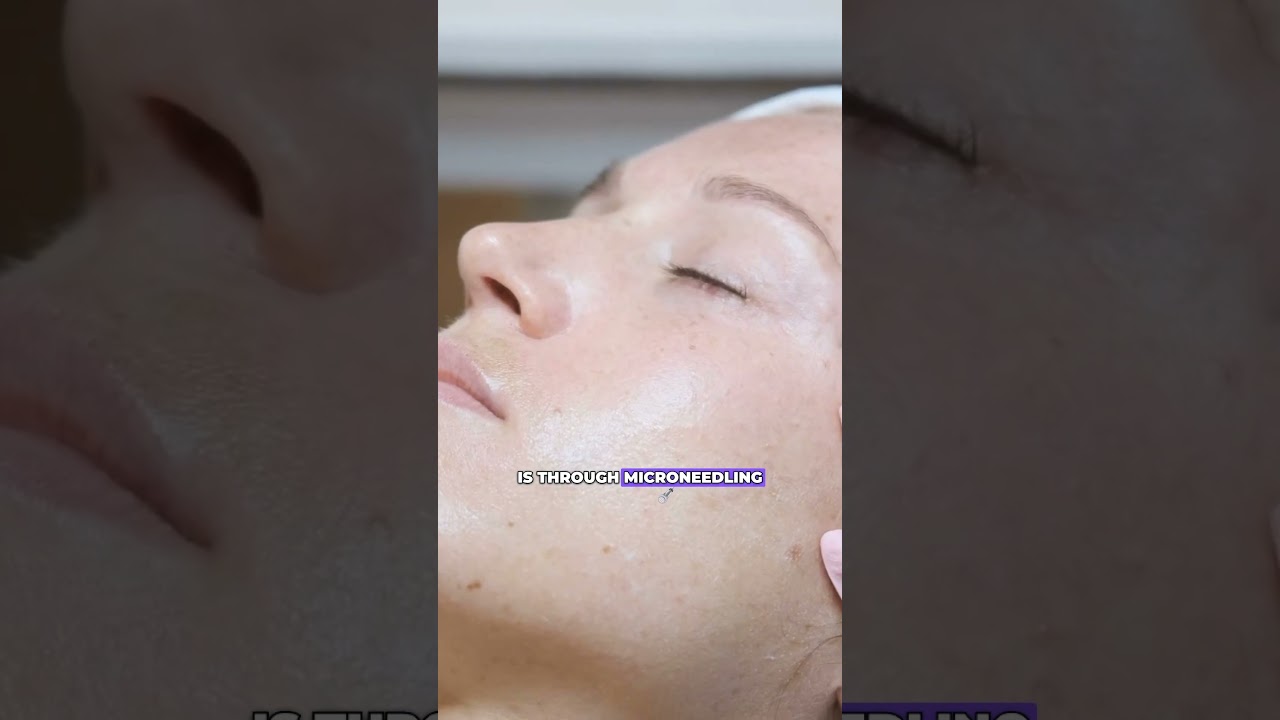 Tranexamic Acid - a game-changer for melasma?