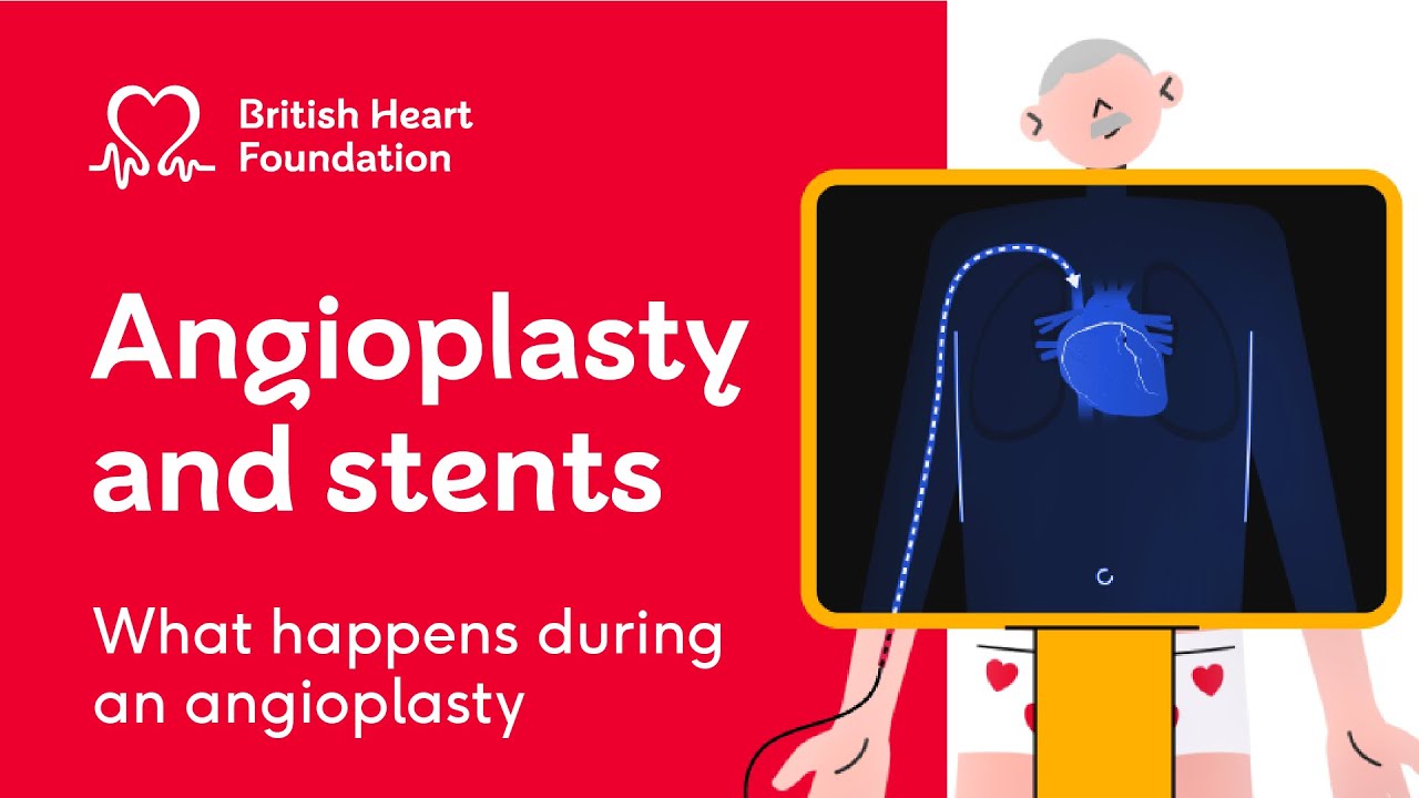 What is an angioplasty and stents? – BHF