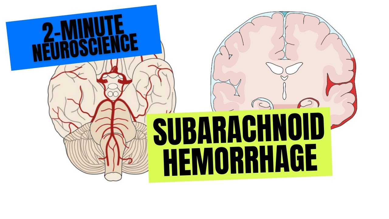 2-Minute Neuroscience: Subarachnoid Hemorrhage