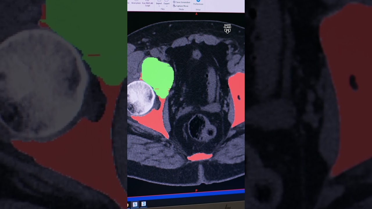 Colon cancer is on the rise. AI is helping to detect it early. [Ad Content from Mayo Clinic]