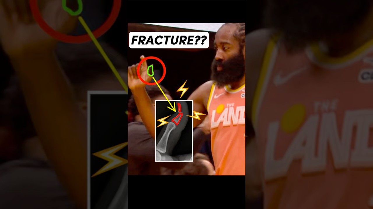 Doctor explains #JamesHarden THUMB fracture #SportsMedicine #Cavaliers #ClevelandCavaliers #Injury
