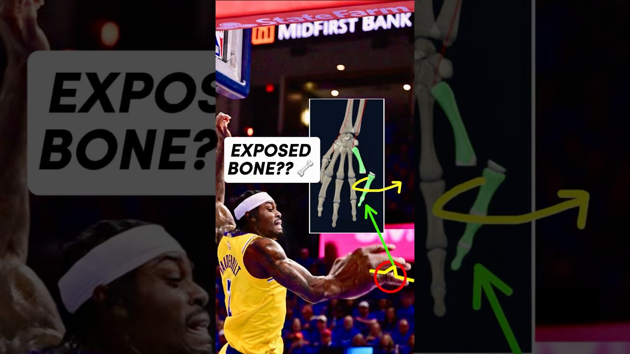 Doctor Explains Jared Vanderbilt’s Graphic Finger Injury #Lakers #SportsMedicine